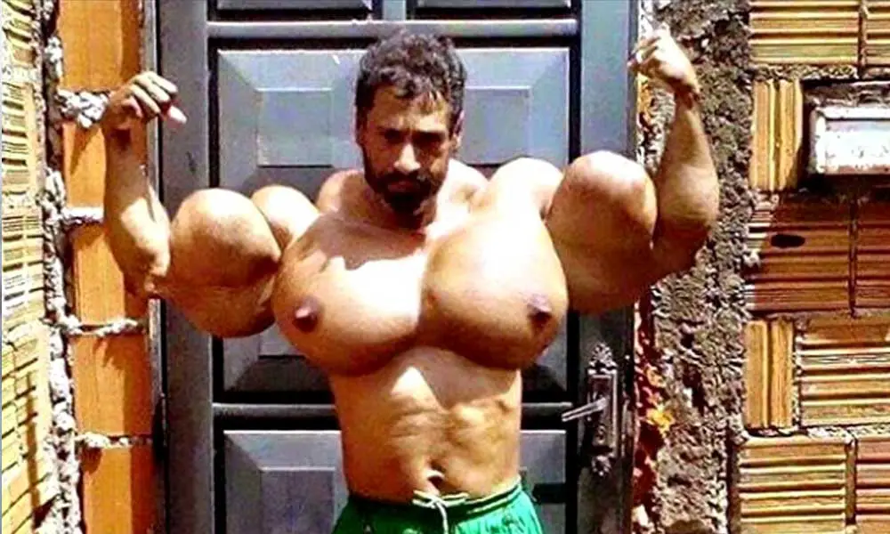 Bodybuilder pumps Synthol into his muscles and now looks like this