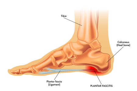Are Skechers Bad for Your Feet? Are Skechers Bad for Plantar Fasciitis?
