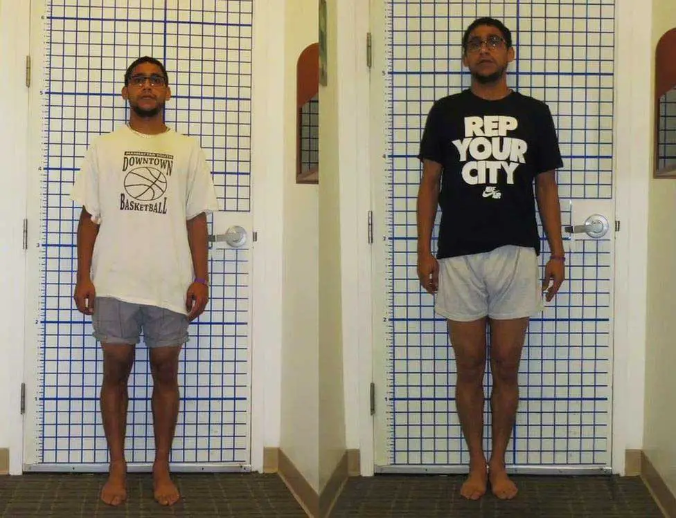 Is It Better to Have a Long or Short Torso? Exploring Body Proportions 7 longer torso leg lengthening surgery